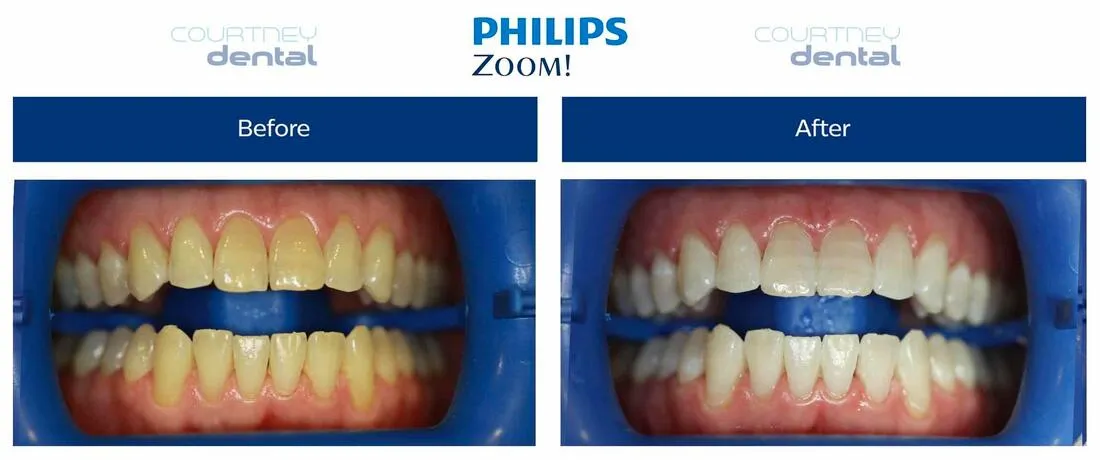 29426 zoom whitening before after