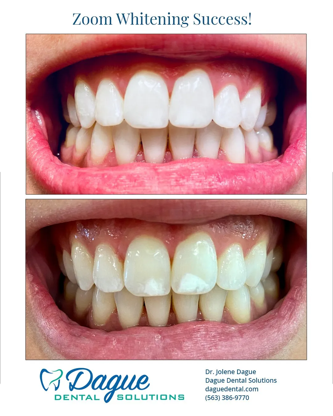 29426 zoom whitening benefits