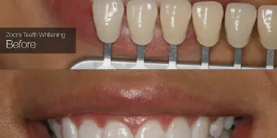 /img/29426-zoom-whitening-maintenance.webp
