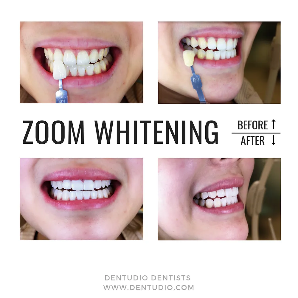29426 zoom whitening science