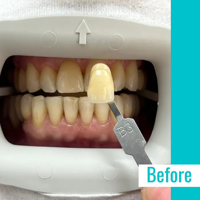 29427 at home teeth whitening kit