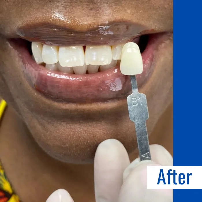 29427 dental cleaning teeth whitening