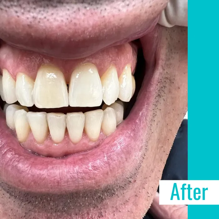 29427 la dentist teeth whitening