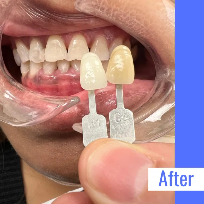 29427 teeth whitening before after