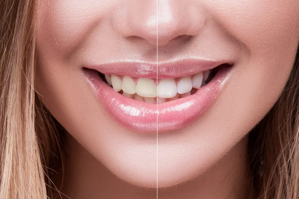 29427 teeth whitening maintenance