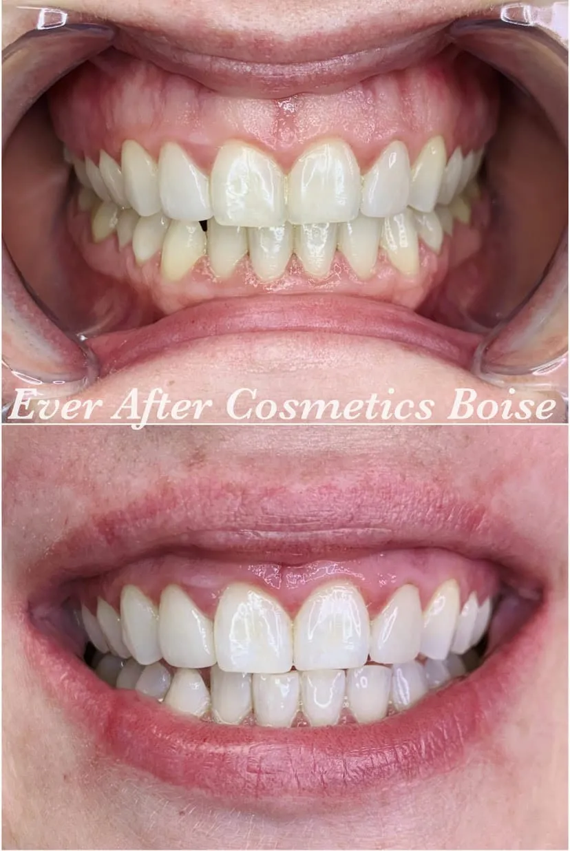 /img/29430-boise-teeth-whitening-cost.webp