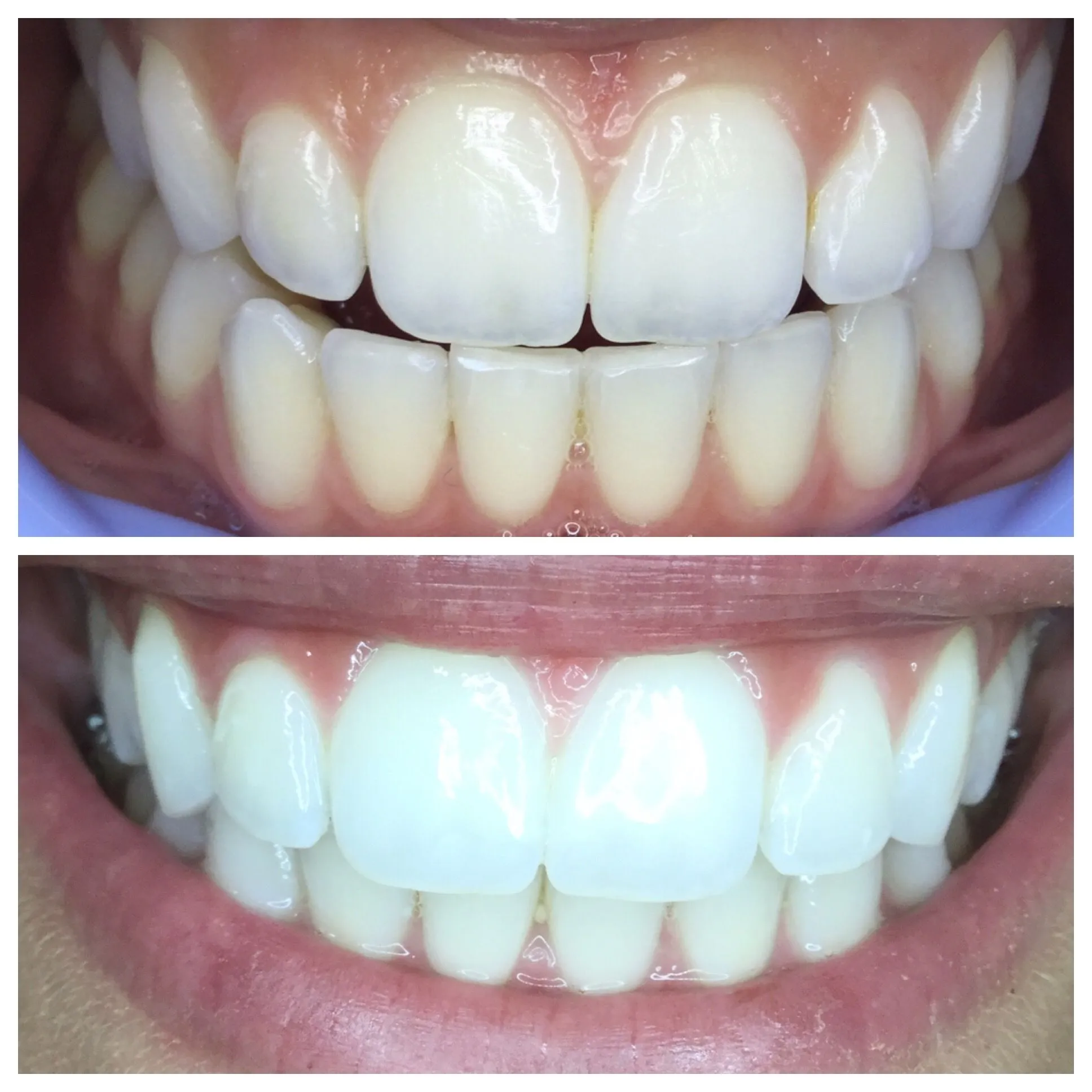 29430 boise teeth whitening professional