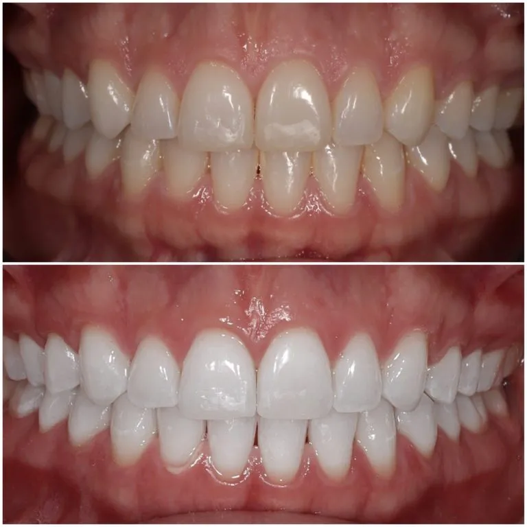 29430 teeth whitening foods drinks