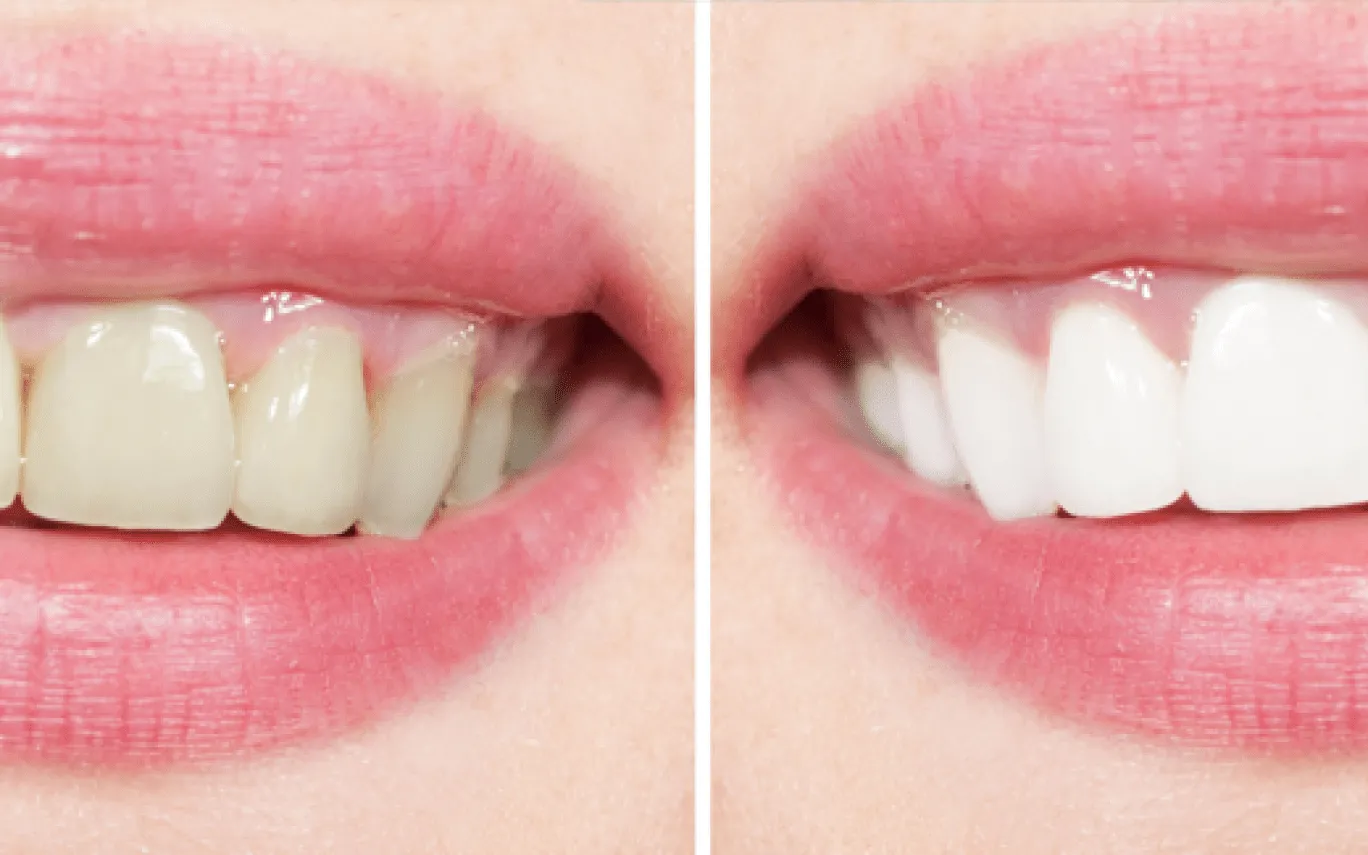 29430 teeth whitening trays