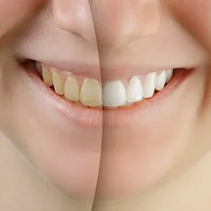 29431 zoom teeth whitening raleigh nc procedure