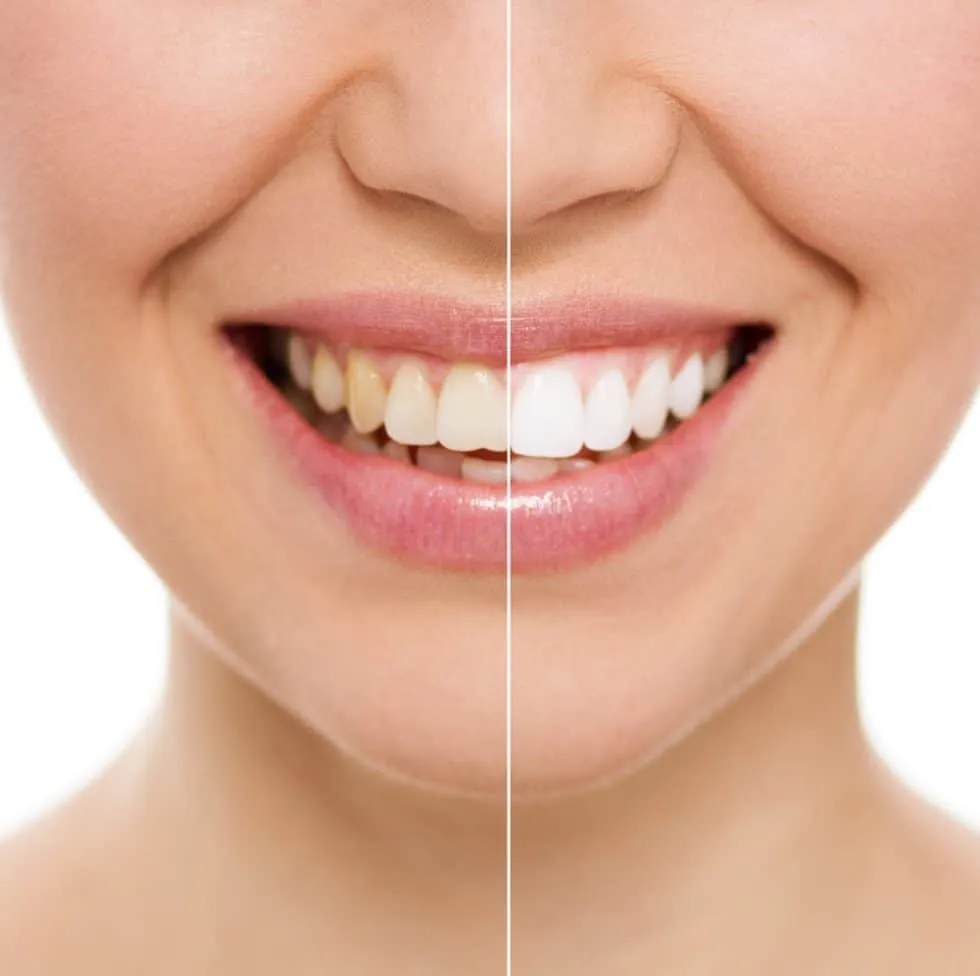 29437 orthodontist teeth whitening before after