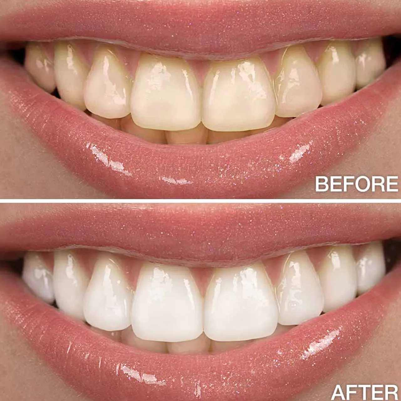 29437 orthodontist teeth whitening diet