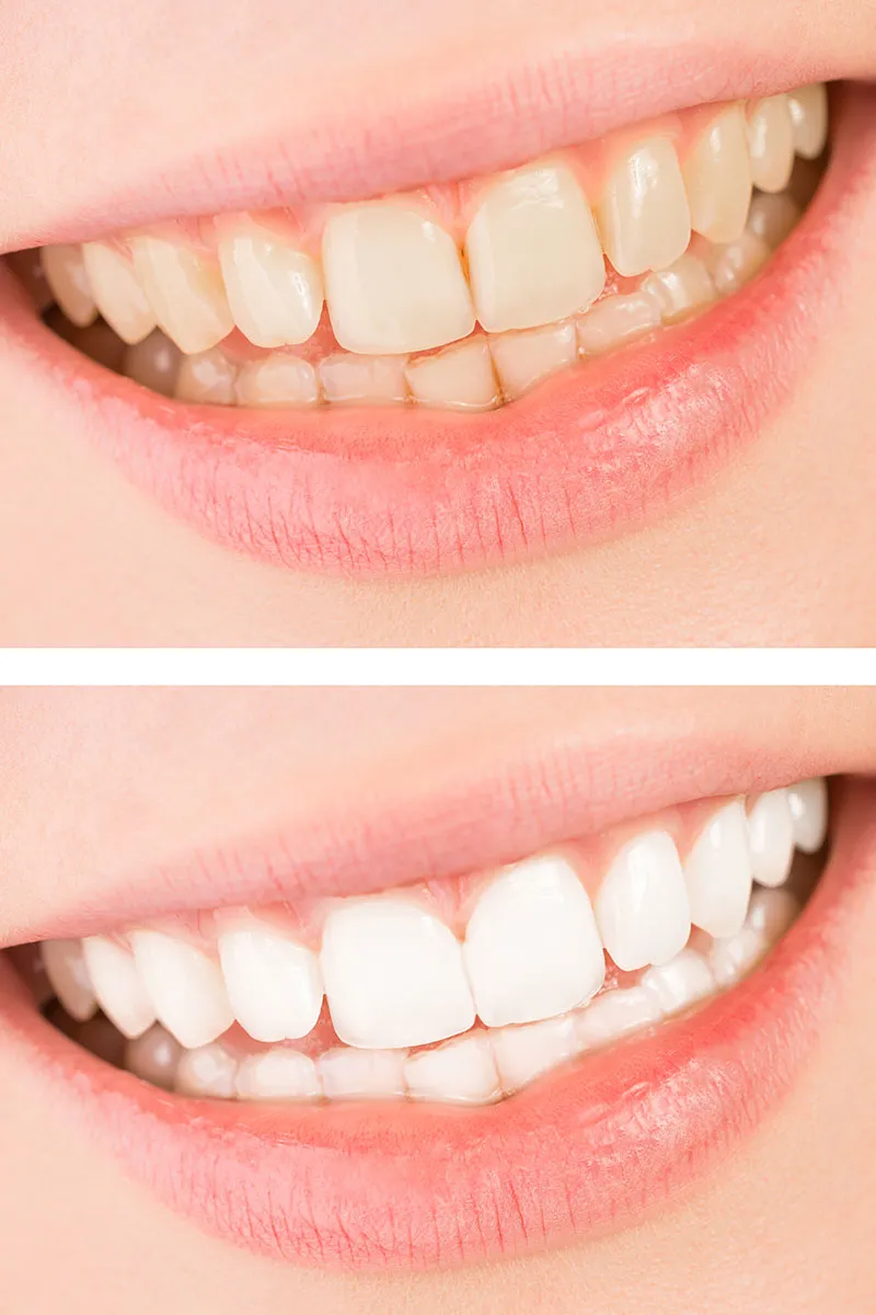 29437 orthodontist teeth whitening procedure