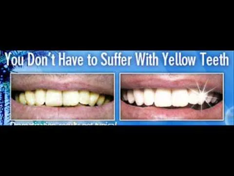 29440 teeth sensitivity