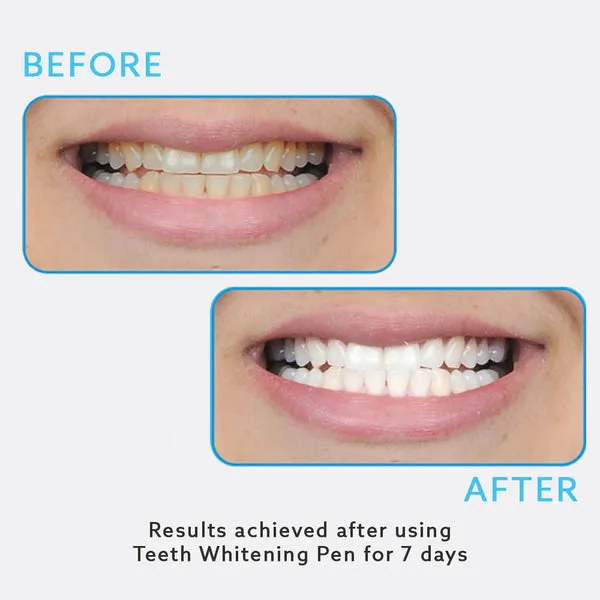 29440 teeth whitening review