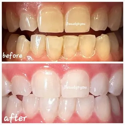 29444 teeth whitening options visalia ca
