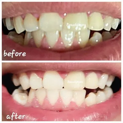 29444 visalia ca dentist teeth whitening