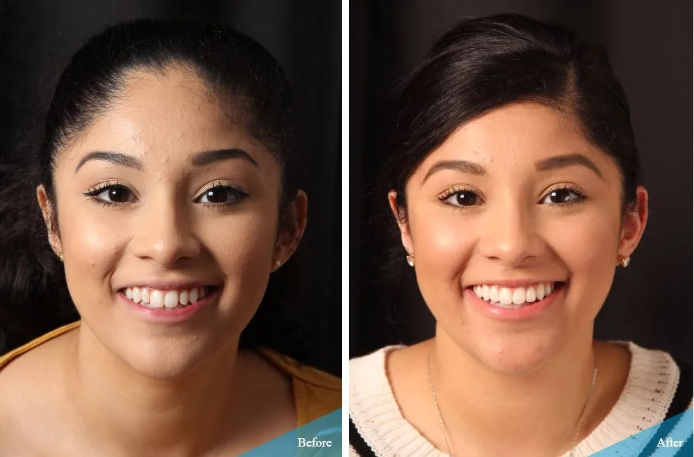 29446 foods to avoid teeth whitening