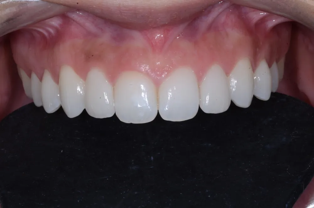 29446 teeth whitening maintenance