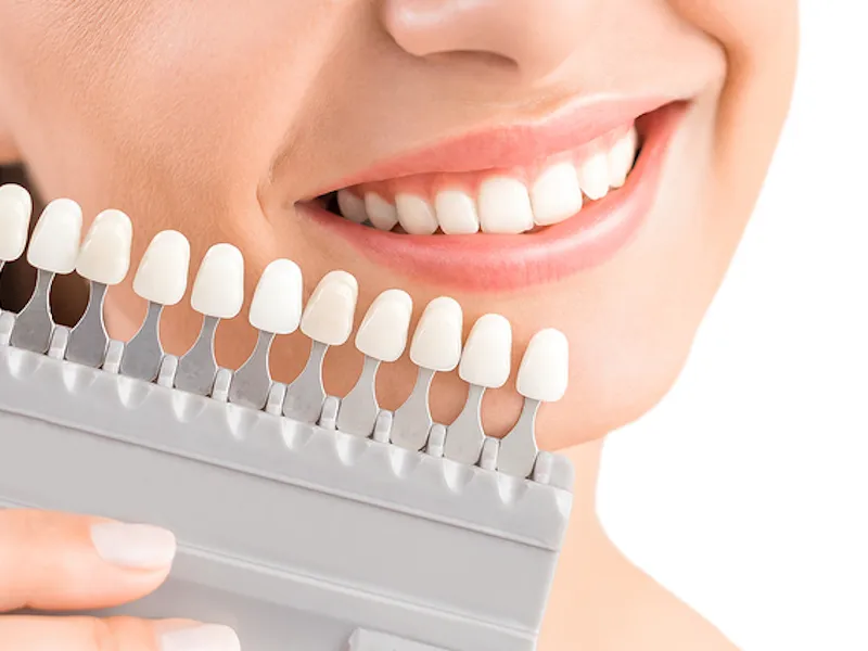 29446 types of teeth whitening