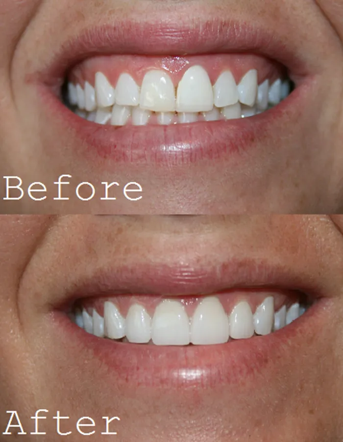 29450 teeth whitening cost