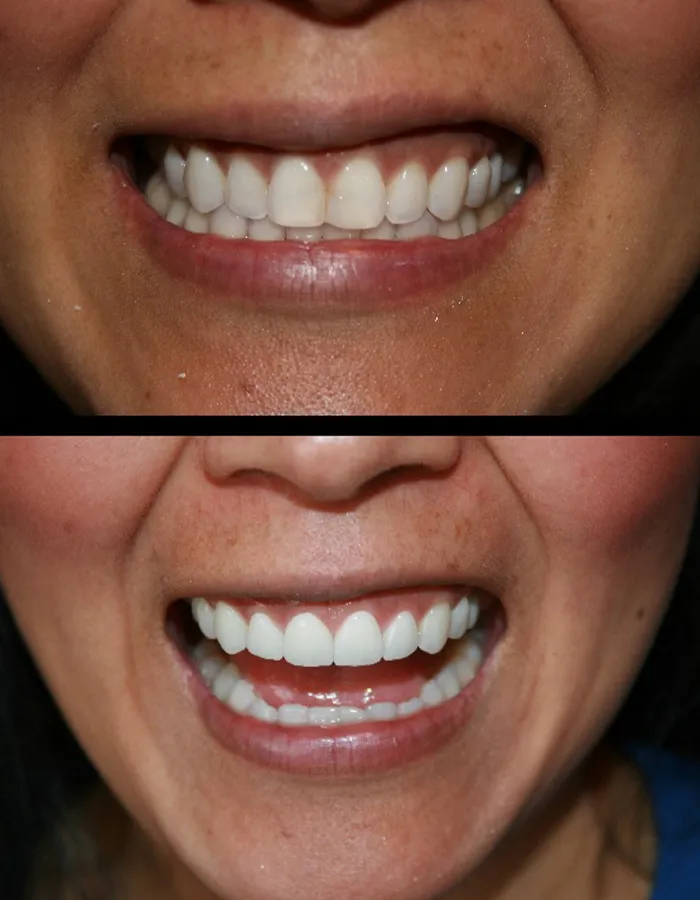 29450 teeth whitening results