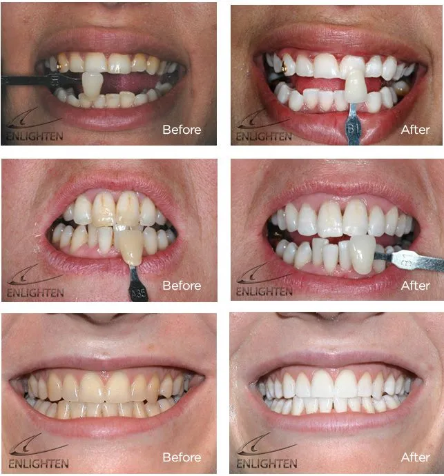 29452 at home teeth whitening