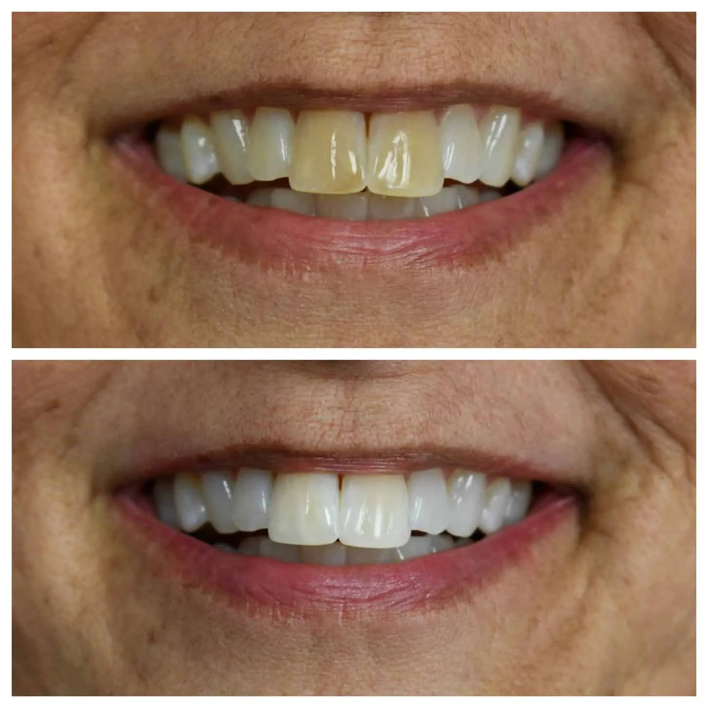 29456 professional teeth whitening