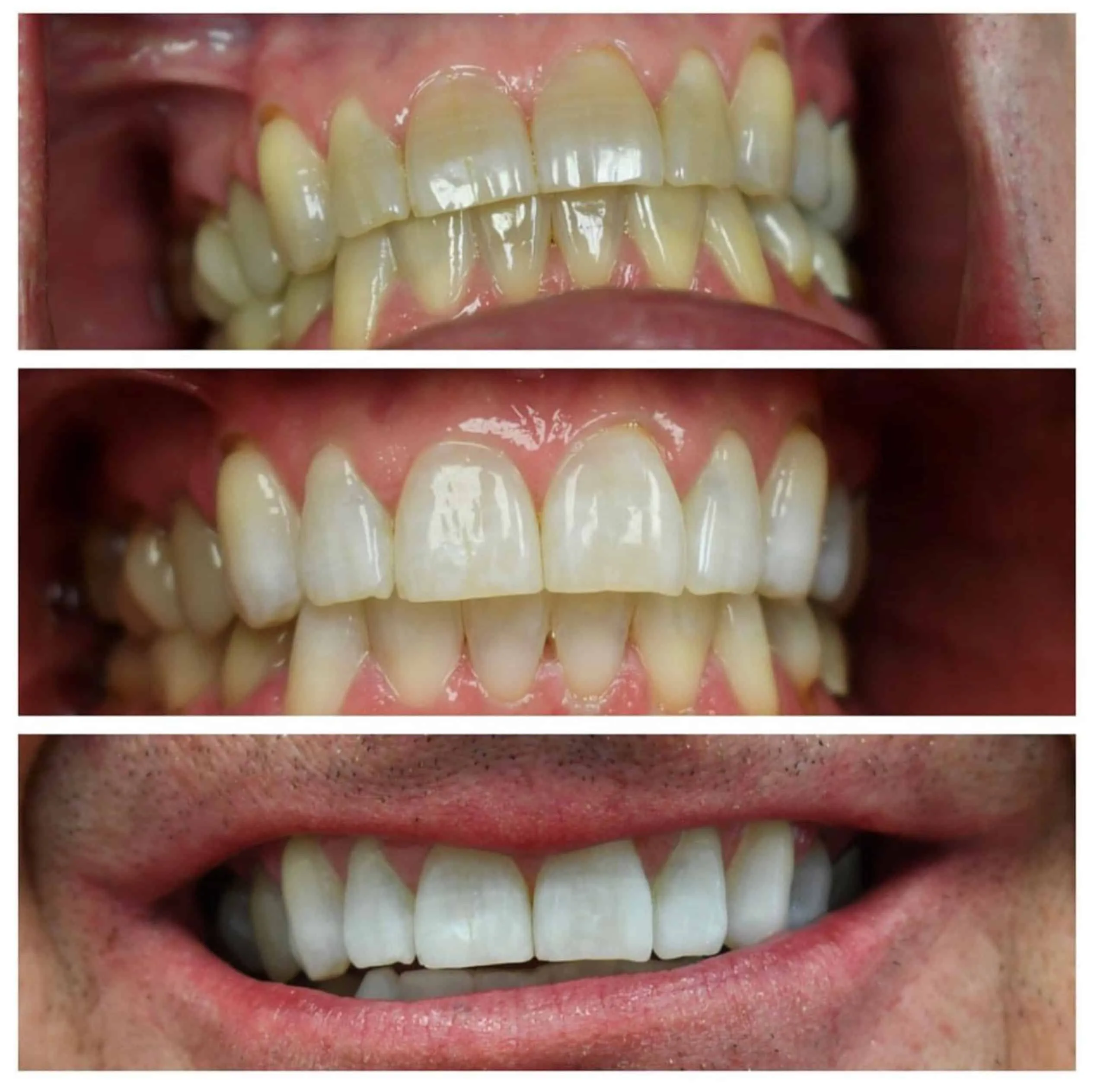 29456 teeth whitening care