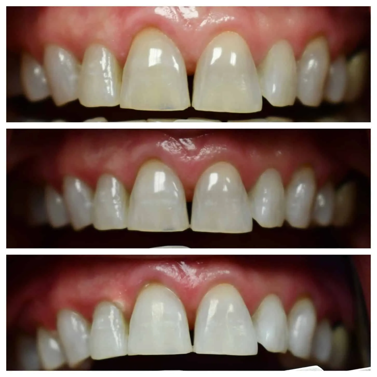 29456 teeth whitening options