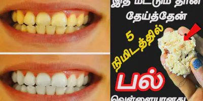 /img/29458-whitening-teeth-tamil.webp