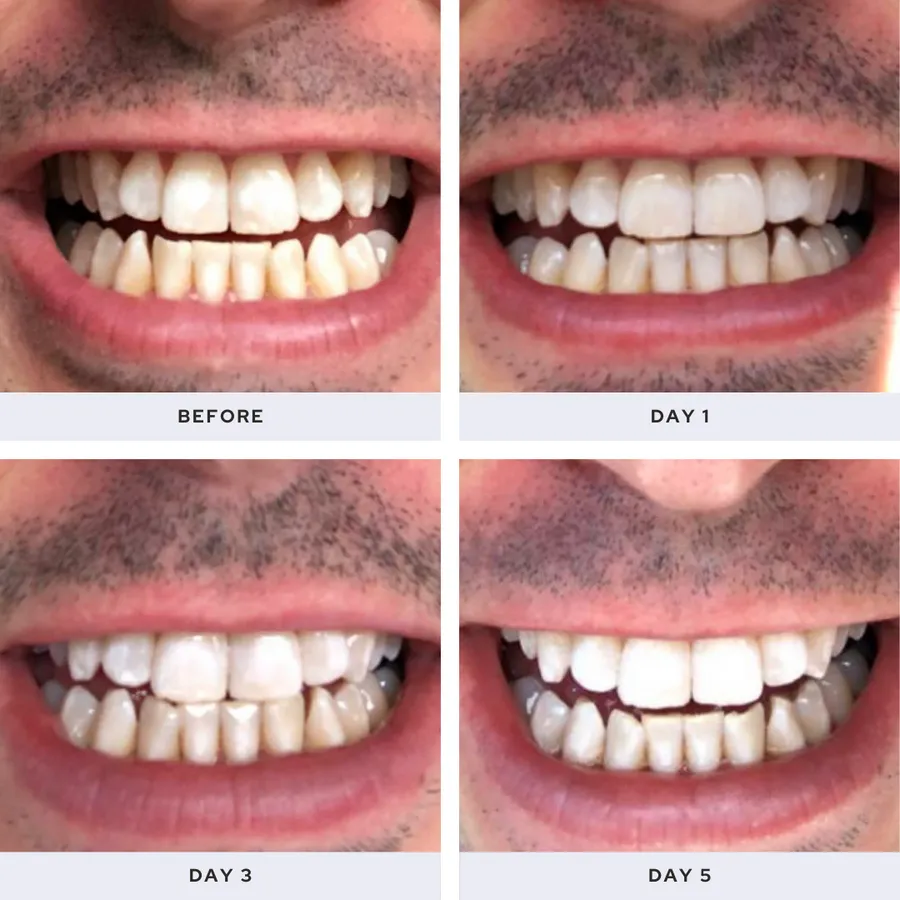 29462 teeth whitening killarney oral health
