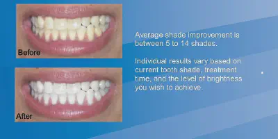 /img/29462-teeth-whitening-killarney-smile.webp