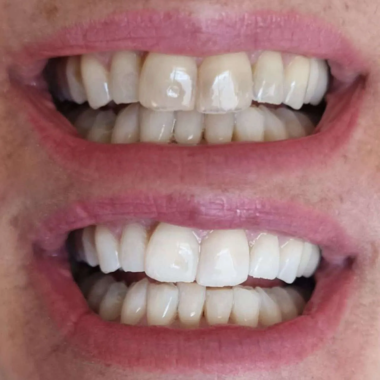 29463 teeth whitening perth wa cost effective