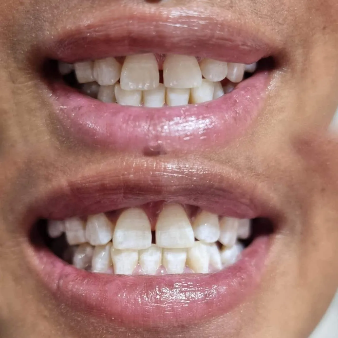 29463 teeth whitening perth wa oral health