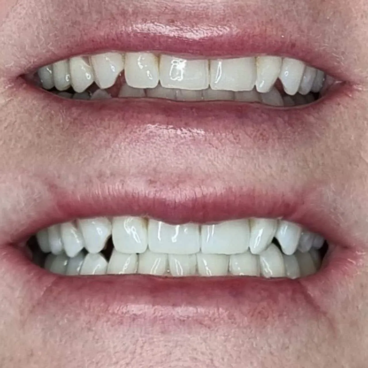 29463 teeth whitening perth wa procedure
