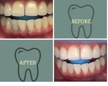 29465 in office teeth whitening