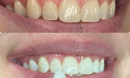 29465 teeth whitening appointment preparation