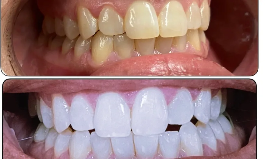 29465 teeth whitening comparison chart