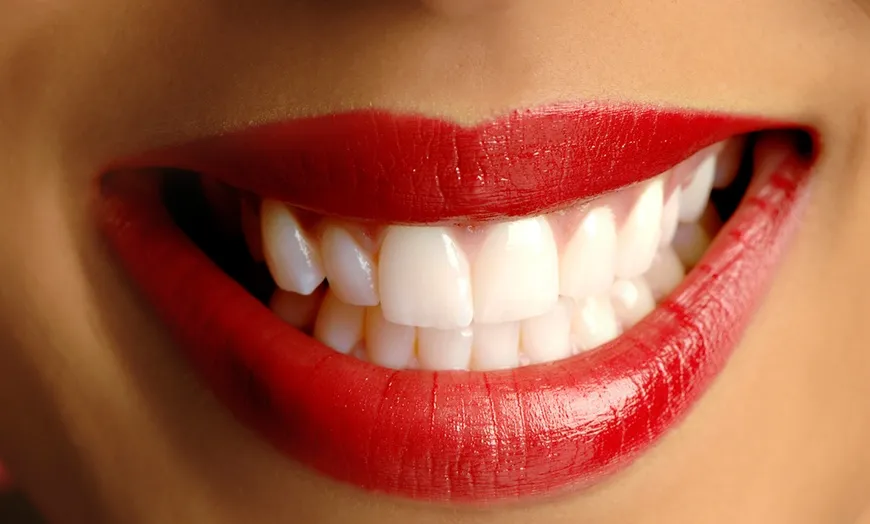 29467 teeth whitening aftercare