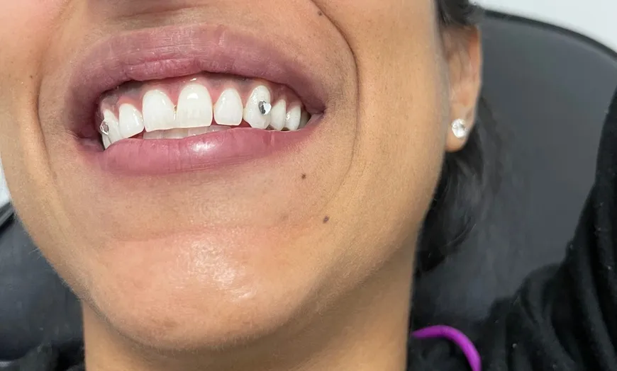 29467 teeth whitening treatment