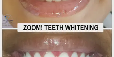 /img/29471-zoom-teeth-whitening-benefits.webp