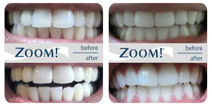 29471 zoom whitening case study 1