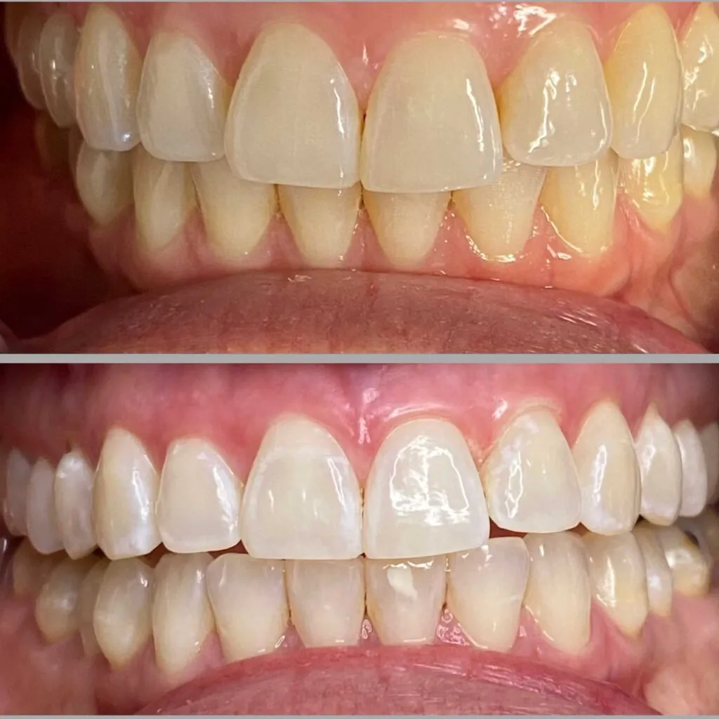 29478 professional teeth whitening