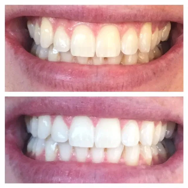 29478 teeth whitening arizona oral health