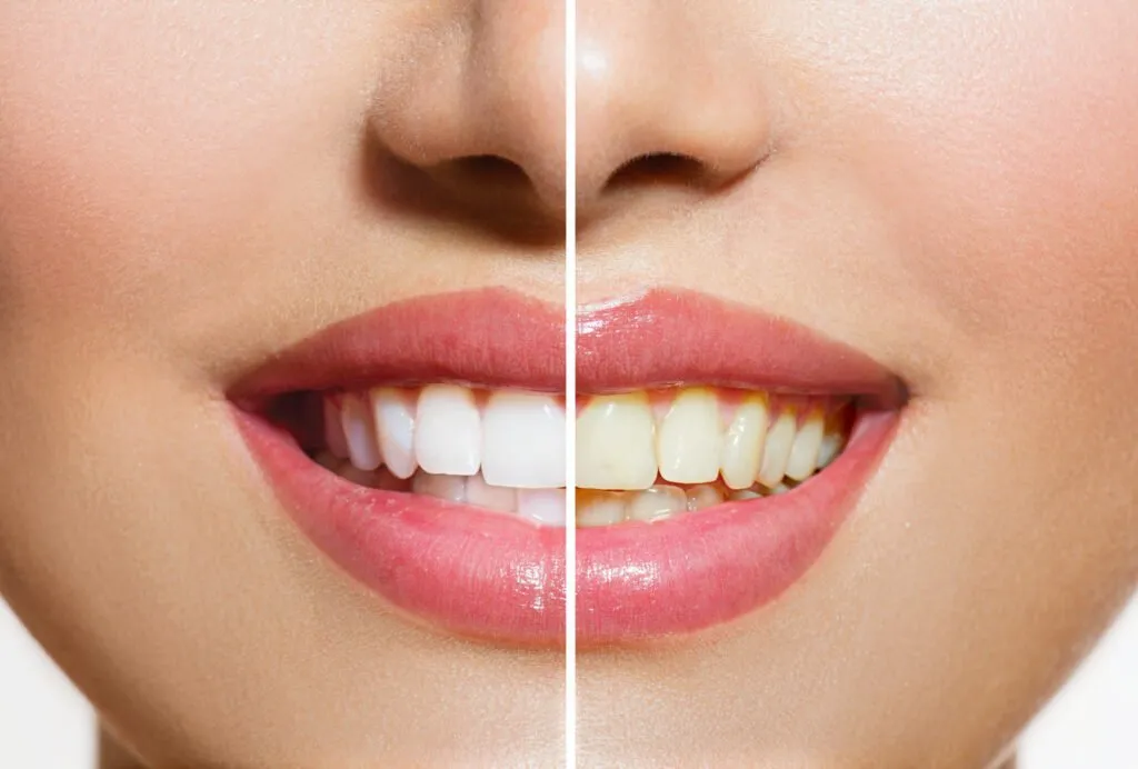 29478 teeth whitening arizona procedure