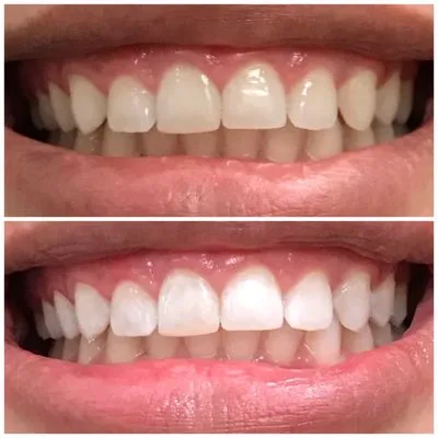 29479 at home teeth whitening kits