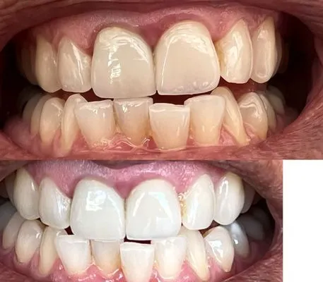 29479 teeth whitening cost gilbert az