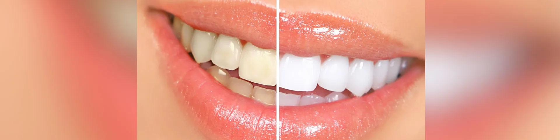 29479 teeth whitening gilbert az overview