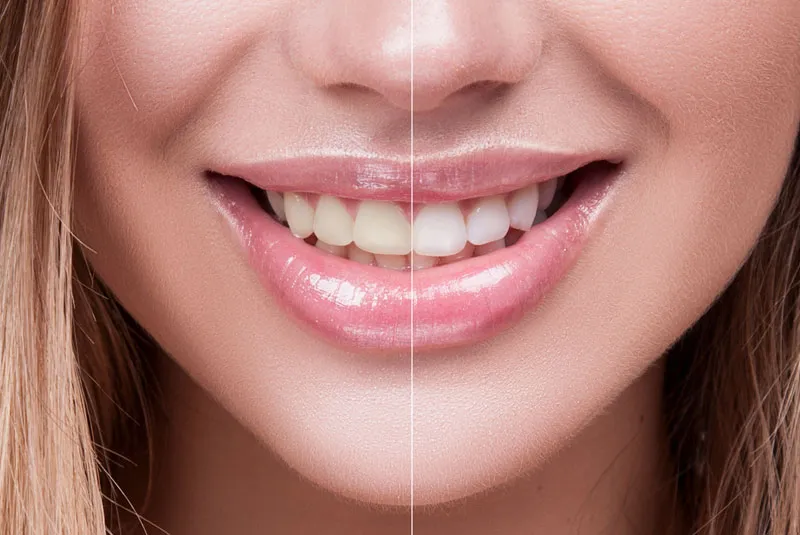29479 types of teeth whitening